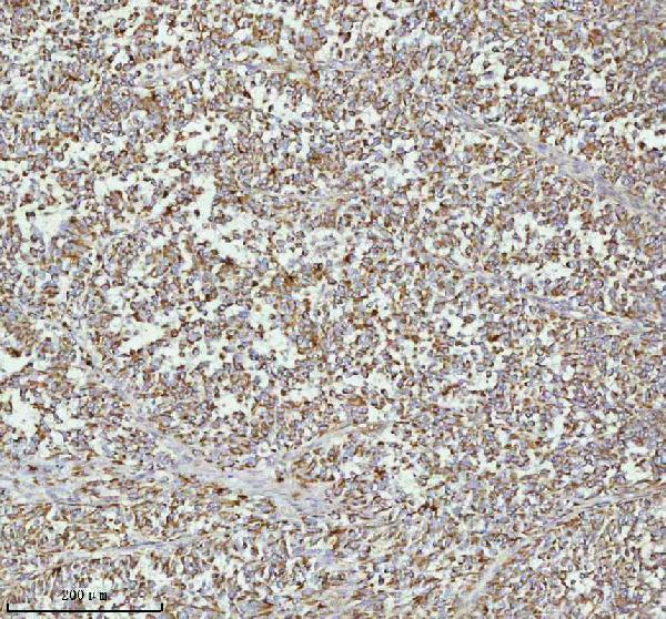 Figure 3. IHC analysis of MELTF using anti-MELTF antibody (A12988-1). MELTF was detected in a paraffin-embedded section of human melanoma cancer tissue. Heat mediated antigen retrieval was performed in EDTA buffer (pH 8.0, epitope retrieval solution). The tissue section was blocked with 10% goat serum. The tissue section was then incubated with 2 microg/ml rabbit anti-MELTF Antibody (A12988-1) overnight at 4°C. Peroxidase Conjugated Goat Anti-rabbit IgG was used as secondary antibody and incubated for 30 minutes at 37°C. The tissue section was developed using HRP Conjugated Rabbit IgG Super Vision Assay Kit (Catalog # SV0002) with DAB as the chromogen.