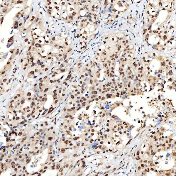 Figure 2. IHC analysis of SNRNP40 using anti-SNRNP40 antibody (A12991-2). SNRNP40 was detected in a paraffin-embedded section of human appendix adenocarcinoma tissue. Heat mediated antigen retrieval was performed in EDTA buffer (pH 8.0, epitope retrieval solution). The tissue section was blocked with 10% goat serum. The tissue section was then incubated with 2 microg/ml rabbit anti-SNRNP40 Antibody (A12991-2) overnight at 4°C. Peroxidase Conjugated Goat Anti-rabbit IgG was used as secondary antibody and incubated for 30 minutes at 37°C. The tissue section was developed using HRP Conjugated Rabbit IgG Super Vision Assay Kit (Catalog # SV0002) with DAB as the chromogen.