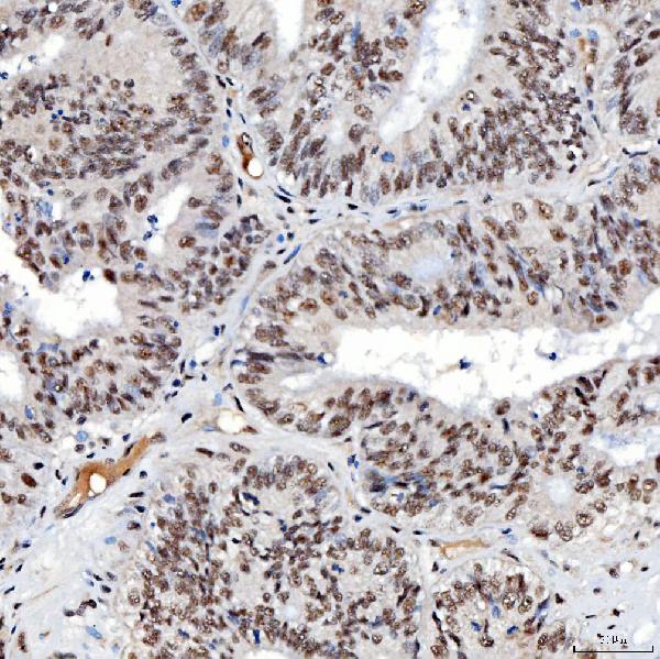 Figure 4. IHC analysis of SNRNP40 using anti-SNRNP40 antibody (A12991-2). SNRNP40 was detected in a paraffin-embedded section of human endometrioid adenocarcinoma tissue. Heat mediated antigen retrieval was performed in EDTA buffer (pH 8.0, epitope retrieval solution). The tissue section was blocked with 10% goat serum. The tissue section was then incubated with 2 microg/ml rabbit anti-SNRNP40 Antibody (A12991-2) overnight at 4°C. Peroxidase Conjugated Goat Anti-rabbit IgG was used as secondary antibody and incubated for 30 minutes at 37°C. The tissue section was developed using HRP Conjugated Rabbit IgG Super Vision Assay Kit (Catalog # SV0002) with DAB as the chromogen.