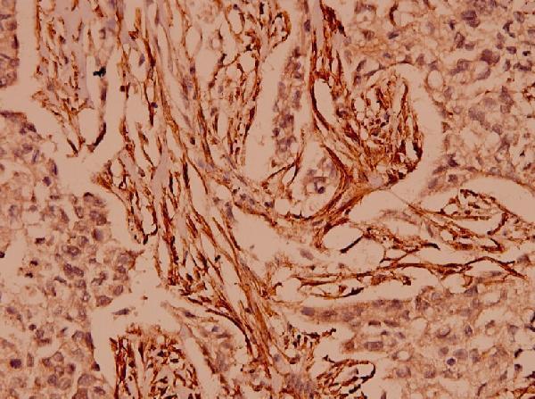 Immunohistochemistry (IHC) analyzes of CARD6 (A2) pAb in paraffin-embedded human breast carcinoma tissue at 1:100