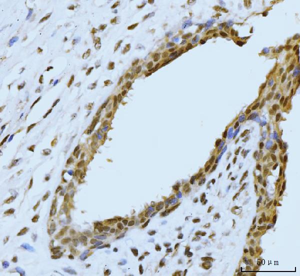 Figure 3. IHC analysis of SBNO1 using anti-SBNO1 antibody (A13130). SBNO1 was detected in a paraffin-embedded section of human breast cancer tissue. Heat mediated antigen retrieval was performed in EDTA buffer (pH 8.0, epitope retrieval solution). The tissue section was blocked with 10% goat serum. The tissue section was then incubated with 2 microg/ml rabbit anti-SBNO1 Antibody (A13130) overnight at 4°C. Biotinylated goat anti-rabbit IgG was used as secondary antibody and incubated for 30 minutes at 37°C. The tissue section was developed using Strepavidin-Biotin-Complex (SABC) (Catalog # SA1022) with DAB as the chromogen.