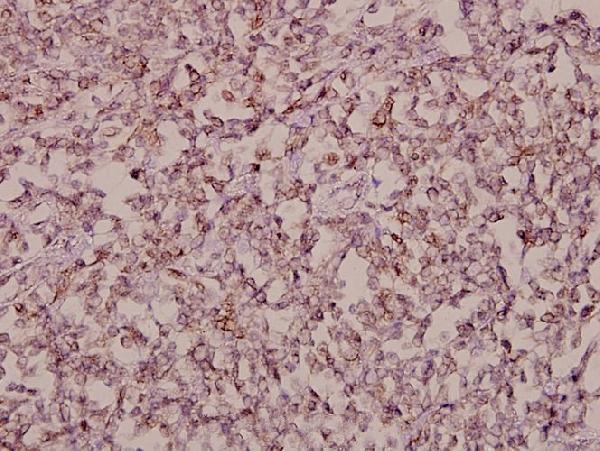 Immunohistochemistry (IHC) analyzes of Stonin-1 (W718) pAb in paraffin-embedded human tonsil carcinoma tissue at 1:50