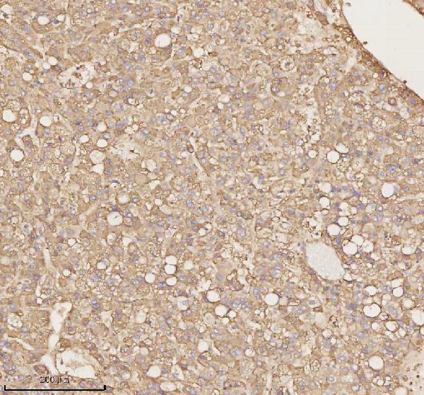 Figure 4. IHC analysis of PTCD1 using anti-PTCD1 antibody (A13208-1). PTCD1 was detected in a paraffin-embedded section of human liver cancer tissue. Heat mediated antigen retrieval was performed in EDTA buffer (pH 8.0, epitope retrieval solution). The tissue section was blocked with 10% goat serum. The tissue section was then incubated with 2 microg/ml rabbit anti-PTCD1 Antibody (A13208-1) overnight at 4°C. Peroxidase Conjugated Goat Anti-rabbit IgG was used as secondary antibody and incubated for 30 minutes at 37°C. The tissue section was developed using HRP Conjugated Rabbit IgG Super Vision Assay Kit (Catalog # SV0002) with DAB as the chromogen. Figure 4. IHC analysis of PTCD1 using anti-PTCD1 antibody (A13208-1). PTCD1 was detected in a paraffin-embedded section of human liver cancer tissue. Heat mediated antigen retrieval was performed in EDTA buffer (pH 8.0, epitope retrieval solution). The tissue section was blocked with 10% goat serum. The tissue section was then incubated with 2 microg/ml rabbit anti-PTCD1 Antibody (A13208-1) overnight at 4°C. Peroxidase Conjugated Goat Anti-rabbit IgG was used as secondary antibody and incubated for 30 minutes at 37°C. The tissue section was developed using HRP Conjugated Rabbit IgG Super Vision Assay Kit (Catalog # SV0002) with DAB as the chromogen.