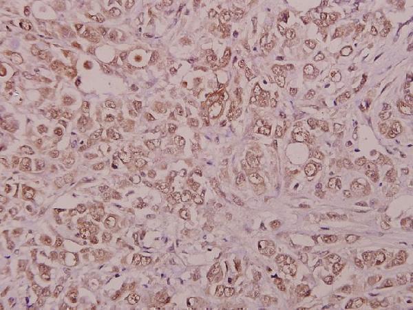 Immunohistochemistry (IHC) analyzes of PIG11 (P93) pAb in paraffin-embedded human colorectal carcinoma tissue at 1:50