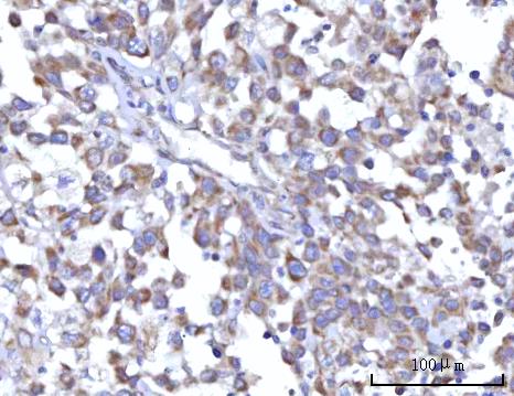 Figure 3. IHC analysis of C18orf22/RBFA using anti-C18orf22/RBFA antibody (A13257-1). C18orf22/RBFA was detected in a paraffin-embedded section of human undifferentiated carcinoma of pancreas tissue. Heat mediated antigen retrieval was performed in EDTA buffer (pH 8.0, epitope retrieval solution). The tissue section was blocked with 10% goat serum. The tissue section was then incubated with 2 microg/ml rabbit anti-C18orf22/RBFA Antibody (A13257-1) overnight at 4°C. Peroxidase Conjugated Goat Anti-rabbit IgG was used as secondary antibody and incubated for 30 minutes at 37°C. The tissue section was developed using HRP Conjugated Rabbit IgG Super Vision Assay Kit (Catalog # SV0002) with DAB as the chromogen.