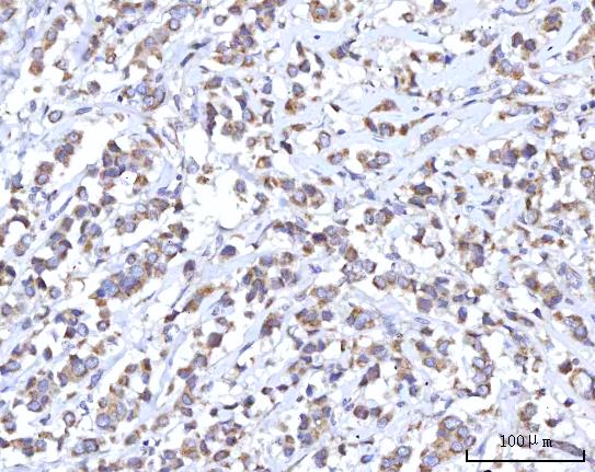 Figure 5. IHC analysis of C18orf22/RBFA using anti-C18orf22/RBFA antibody (A13257-1). C18orf22/RBFA was detected in a paraffin-embedded section of human breast cancer tissue. Heat mediated antigen retrieval was performed in EDTA buffer (pH 8.0, epitope retrieval solution). The tissue section was blocked with 10% goat serum. The tissue section was then incubated with 2 microg/ml rabbit anti-C18orf22/RBFA Antibody (A13257-1) overnight at 4°C. Peroxidase Conjugated Goat Anti-rabbit IgG was used as secondary antibody and incubated for 30 minutes at 37°C. The tissue section was developed using HRP Conjugated Rabbit IgG Super Vision Assay Kit (Catalog # SV0002) with DAB as the chromogen.