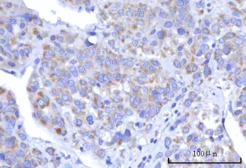 Figure 7. IHC analysis of C18orf22/RBFA using anti-C18orf22/RBFA antibody (A13257-1). C18orf22/RBFA was detected in a paraffin-embedded section of human liver cancer tissue. Heat mediated antigen retrieval was performed in EDTA buffer (pH 8.0, epitope retrieval solution). The tissue section was blocked with 10% goat serum. The tissue section was then incubated with 2 microg/ml rabbit anti-C18orf22/RBFA Antibody (A13257-1) overnight at 4°C. Peroxidase Conjugated Goat Anti-rabbit IgG was used as secondary antibody and incubated for 30 minutes at 37°C. The tissue section was developed using HRP Conjugated Rabbit IgG Super Vision Assay Kit (Catalog # SV0002) with DAB as the chromogen.