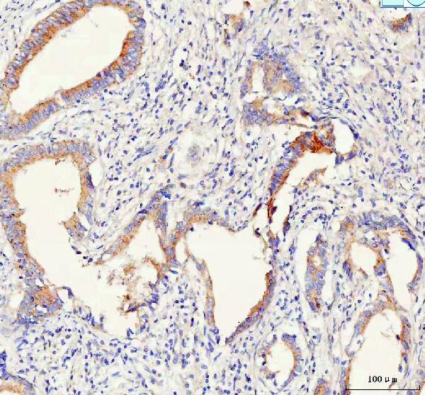 Figure 2. IHC analysis of PCDHB14 using anti-PCDHB14 antibody (A13272-1). PCDHB14 was detected in a paraffin-embedded section of human colorectal adenocarcinoma tissue. Heat mediated antigen retrieval was performed in EDTA buffer (pH 8.0, epitope retrieval solution). The tissue section was blocked with 10% goat serum. The tissue section was then incubated with 2 microg/ml rabbit anti-PCDHB14 Antibody (A13272-1) overnight at 4°C. Peroxidase Conjugated Goat Anti-rabbit IgG was used as secondary antibody and incubated for 30 minutes at 37°C. The tissue section was developed using HRP Conjugated Rabbit IgG Super Vision Assay Kit (Catalog # SV0002) with DAB as the chromogen. Figure 2. IHC analysis of PCDHB14 using anti-PCDHB14 antibody (A13272-1). PCDHB14 was detected in a paraffin-embedded section of human colorectal adenocarcinoma tissue. Heat mediated antigen retrieval was performed in EDTA buffer (pH 8.0, epitope retrieval solution). The tissue section was blocked with 10% goat serum. The tissue section was then incubated with 2 microg/ml rabbit anti-PCDHB14 Antibody (A13272-1) overnight at 4°C. Peroxidase Conjugated Goat Anti-rabbit IgG was used as secondary antibody and incubated for 30 minutes at 37°C. The tissue section was developed using HRP Conjugated Rabbit IgG Super Vision Assay Kit (Catalog # SV0002) with DAB as the chromogen.