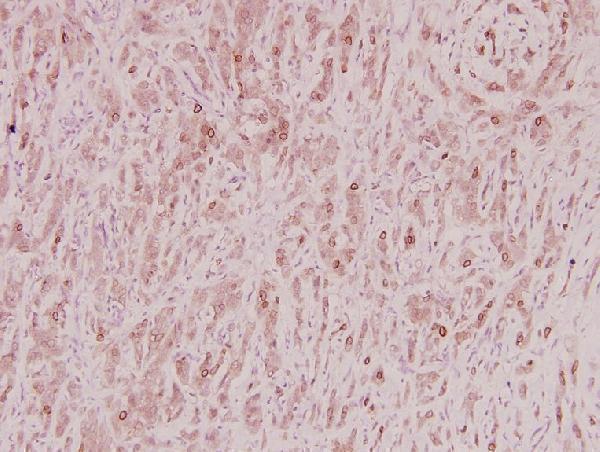 Immunohistochemistry (IHC) analyzes of ZNF23 (Q185) pAb in paraffin-embedded human breast carcinoma tissue at 1:100