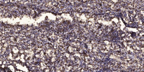 Immunohistochemical analysis of paraffin-embedded human Squamous cell carcinoma of lung