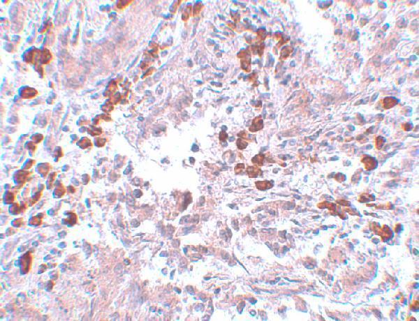 Immunohistochemistry of BCAS1 in human breast carcinoma with BCAS1 antibody at 5 μg/mL