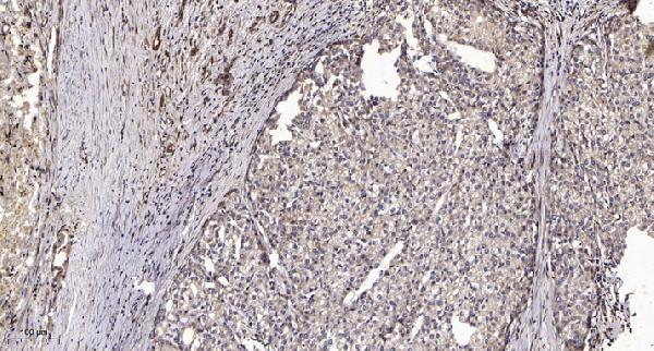 Immunohistochemical analysis of paraffin-embedded human liver cancer