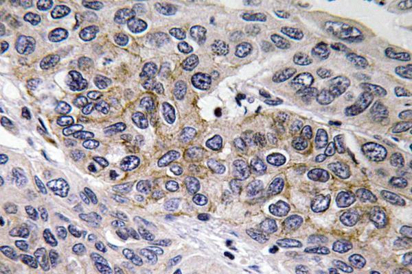 Immunohistochemistry analysis of GCS-β-2 antibody in paraffin-embedded human lung carcinoma tissue