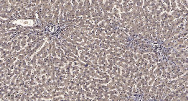 Immunohistochemical analysis of paraffin-embedded human liver cancer