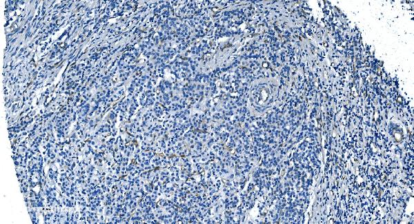 Figure 4. IHC analysis of GNG11 using anti-GNG11 antibody (A13707). GNG11 was detected in paraffin-embedded section of human gastric cancer tissue. Heat mediated antigen retrieval was performed in EDTA buffer (pH8.0, epitope retrieval solution). The tissue section was blocked with 10% goat serum. The tissue section was then incubated with 2microg/ml rabbit anti-GNG11 Antibody (A13707) overnight at 4°C. Biotinylated goat anti-rabbit IgG was used as secondary antibody and incubated for 30 minutes at 37°C. The tissue section was developed using Strepavidin-Biotin-Complex (SABC) (Catalog # SA1022) with DAB as the chromogen.