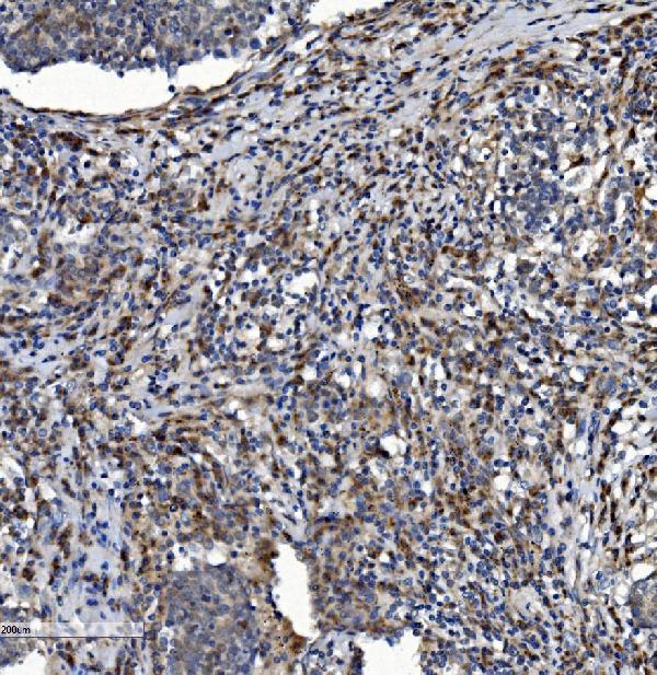 Figure 3. IHC analysis of NDUFB2 using anti-NDUFB2 antibody (A13719-1). NDUFB2 was detected in paraffin-embedded section of human lung cancer tissue. Heat mediated antigen retrieval was performed in EDTA buffer (pH8.0, epitope retrieval solution). The tissue section was blocked with 10% goat serum. The tissue section was then incubated with 2microg/ml rabbit anti-NDUFB2 Antibody (A13719-1) overnight at 4°C. Biotinylated goat anti-rabbit IgG was used as secondary antibody and incubated for 30 minutes at 37°C. The tissue section was developed using Strepavidin-Biotin-Complex (SABC) (Catalog # SA1022) with DAB as the chromogen. Figure 3. IHC analysis of NDUFB2 using anti-NDUFB2 antibody (A13719-1). NDUFB2 was detected in paraffin-embedded section of human lung cancer tissue. Heat mediated antigen retrieval was performed in EDTA buffer (pH8.0, epitope retrieval solution). The tissue section was blocked with 10% goat serum. The tissue section was then incubated with 2microg/ml rabbit anti-NDUFB2 Antibody (A13719-1) overnight at 4°C. Biotinylated goat anti-rabbit IgG was used as secondary antibody and incubated for 30 minutes at 37°C. The tissue section was developed using Strepavidin-Biotin-Complex (SABC) (Catalog # SA1022) with DAB as the chromogen.