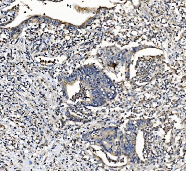 Figure 4. IHC analysis of NDUFB2 using anti-NDUFB2 antibody (A13719-1). NDUFB2 was detected in paraffin-embedded section of human rectal cancer tissue. Heat mediated antigen retrieval was performed in EDTA buffer (pH8.0, epitope retrieval solution). The tissue section was blocked with 10% goat serum. The tissue section was then incubated with 2microg/ml rabbit anti-NDUFB2 Antibody (A13719-1) overnight at 4°C. Biotinylated goat anti-rabbit IgG was used as secondary antibody and incubated for 30 minutes at 37°C. The tissue section was developed using Strepavidin-Biotin-Complex (SABC) (Catalog # SA1022) with DAB as the chromogen. Figure 4. IHC analysis of NDUFB2 using anti-NDUFB2 antibody (A13719-1). NDUFB2 was detected in paraffin-embedded section of human rectal cancer tissue. Heat mediated antigen retrieval was performed in EDTA buffer (pH8.0, epitope retrieval solution). The tissue section was blocked with 10% goat serum. The tissue section was then incubated with 2microg/ml rabbit anti-NDUFB2 Antibody (A13719-1) overnight at 4°C. Biotinylated goat anti-rabbit IgG was used as secondary antibody and incubated for 30 minutes at 37°C. The tissue section was developed using Strepavidin-Biotin-Complex (SABC) (Catalog # SA1022) with DAB as the chromogen.