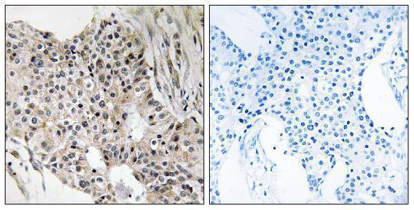 Immunohistochemistry analysis of paraffin-embedded human breast carcinoma tissue, using UEVLD Antibody