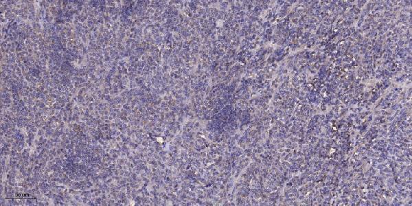 Immunohistochemical analysis of paraffin-embedded human Colon cancer
