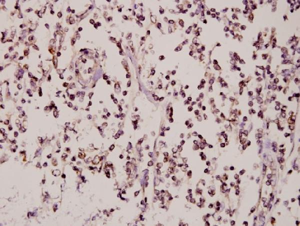 Immunohistochemistry (IHC) analyzes of ZNF174 (E209) pAb in paraffin-embedded human tonsil carcinoma tissue at 1:50