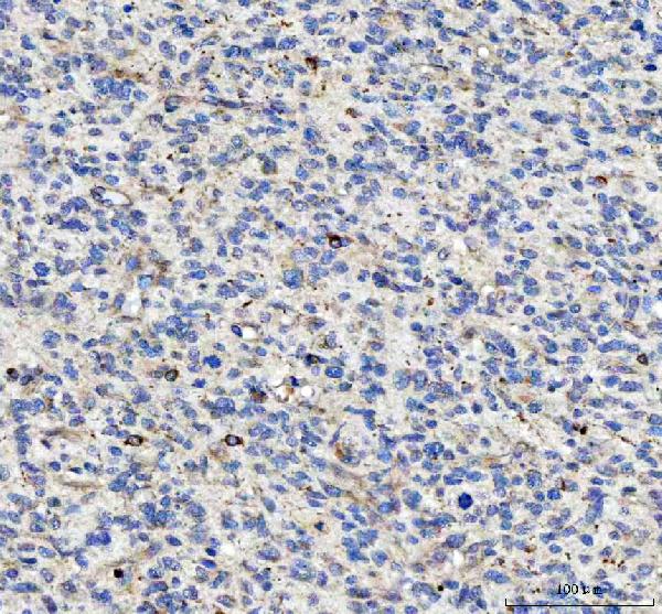 Figure 3. IHC analysis of C2orf43/LDAH using anti-C2orf43/LDAH antibody (A13985). C2orf43/LDAH was detected in a paraffin-embedded section of human glioma tissue. Heat mediated antigen retrieval was performed in EDTA buffer (pH 8.0, epitope retrieval solution). The tissue section was blocked with 10% goat serum. The tissue section was then incubated with 2 microg/ml rabbit anti-C2orf43/LDAH Antibody (A13985) overnight at 4°C. Peroxidase Conjugated Goat Anti-rabbit IgG was used as secondary antibody and incubated for 30 minutes at 37°C. The tissue section was developed using HRP Conjugated Rabbit IgG Super Vision Assay Kit (Catalog # SV0002) with DAB as the chromogen. Figure 3. IHC analysis of C2orf43/LDAH using anti-C2orf43/LDAH antibody (A13985). C2orf43/LDAH was detected in a paraffin-embedded section of human glioma tissue. Heat mediated antigen retrieval was performed in EDTA buffer (pH 8.0, epitope retrieval solution). The tissue section was blocked with 10% goat serum. The tissue section was then incubated with 2 microg/ml rabbit anti-C2orf43/LDAH Antibody (A13985) overnight at 4°C. Peroxidase Conjugated Goat Anti-rabbit IgG was used as secondary antibody and incubated for 30 minutes at 37°C. The tissue section was developed using HRP Conjugated Rabbit IgG Super Vision Assay Kit (Catalog # SV0002) with DAB as the chromogen.