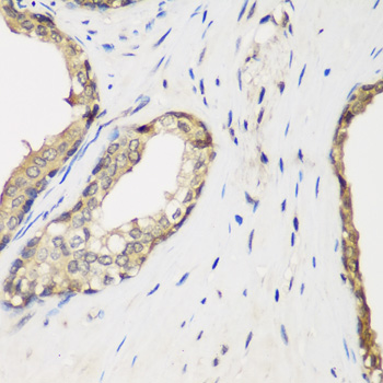 Immunohistochemistry of paraffin-embedded human liver cancer using METTL7A Rabbit pAb  at dilution of 1:25 