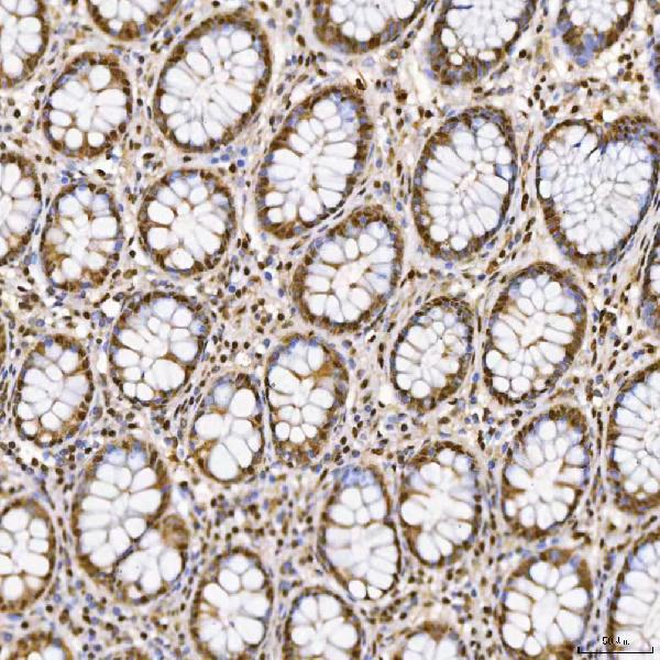 Figure 5. IHC analysis of SNRNP27 using anti-SNRNP27 antibody (A14283-1). SNRNP27 was detected in a paraffin-embedded section of human colon adenocarcinoma tissue. Heat mediated antigen retrieval was performed in EDTA buffer (pH 8.0, epitope retrieval solution). The tissue section was blocked with 10% goat serum. The tissue section was then incubated with 2 microg/ml rabbit anti-SNRNP27 Antibody (A14283-1) overnight at 4°C. Peroxidase Conjugated Goat Anti-rabbit IgG was used as secondary antibody and incubated for 30 minutes at 37°C. The tissue section was developed using HRP Conjugated Rabbit IgG Super Vision Assay Kit (Catalog # SV0002) with DAB as the chromogen.