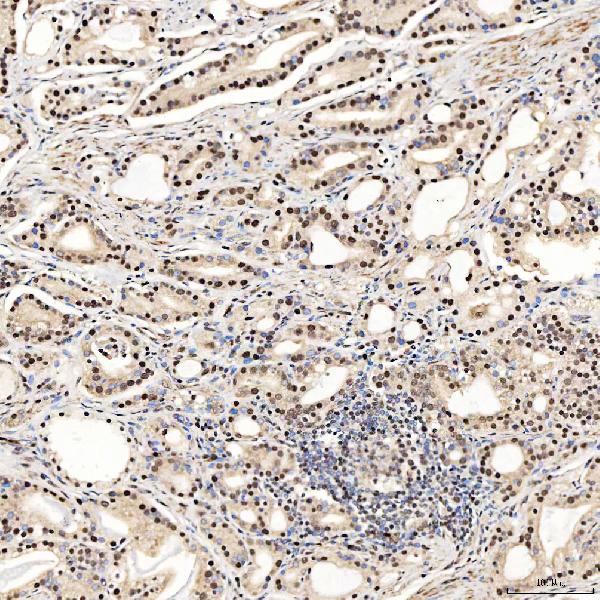 Figure 9. IHC analysis of SNRNP27 using anti-SNRNP27 antibody (A14283-1). SNRNP27 was detected in a paraffin-embedded section of human prostate adenocarcinoma tissue. Heat mediated antigen retrieval was performed in EDTA buffer (pH 8.0, epitope retrieval solution). The tissue section was blocked with 10% goat serum. The tissue section was then incubated with 2 microg/ml rabbit anti-SNRNP27 Antibody (A14283-1) overnight at 4°C. Peroxidase Conjugated Goat Anti-rabbit IgG was used as secondary antibody and incubated for 30 minutes at 37°C. The tissue section was developed using HRP Conjugated Rabbit IgG Super Vision Assay Kit (Catalog # SV0002) with DAB as the chromogen.