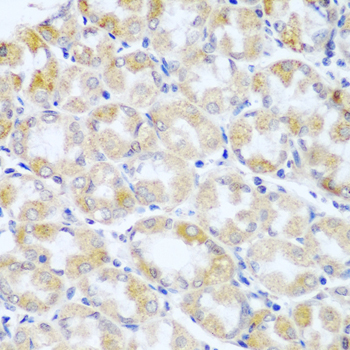 Immunohistochemistry of paraffin-embedded human breast cancer using ANKRD52 antibody  at dilution of 1:100 