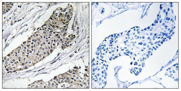 Immunohistochemistry analysis of paraffin-embedded human breast carcinoma tissue, using KCNAB3 Antibody