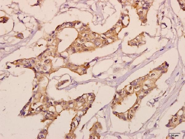 Immunohistochemistry (IHC) analyzes of KDEL Receptor 3 (L95) pAb in paraffin-embedded human breast carcinoma tissue at 1:50