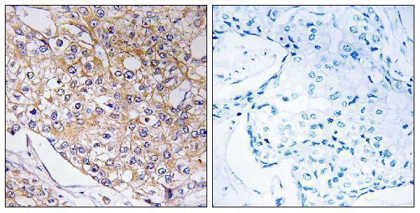 Immunohistochemistry analysis of paraffin-embedded human breast carcinoma tissue, using TRAPPC1 Antibody