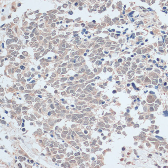 Immunohistochemistry of paraffin-embedded human lung cancer using ZNF581 antibody  at dilution of 1:100 