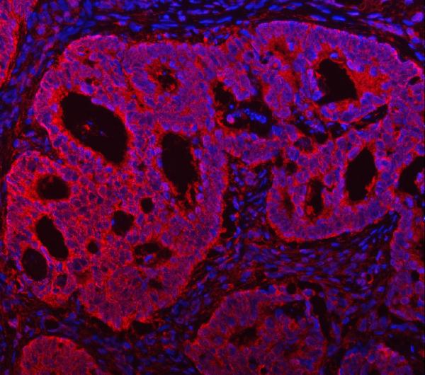 Figure 5. IF analysis of TMC7 using anti-TMC7 antibody (A14820-1). TMC7 was detected in a paraffin-embedded section of human intestinal cancer tissue. Heat mediated antigen retrieval was performed in EDTA buffer (pH 8.0, epitope retrieval solution). The tissue section was blocked with 10% goat serum. The tissue section was then incubated with 5 microg/mL rabbit anti-TMC7 Antibody (A14820-1) overnight at 4°C. DyLight®550 Conjugated Goat Anti-Rabbit IgG (BA1135) was used as secondary antibody at 1:500 dilution and incubated for 30 minutes at 37°C. The section was counterstained with DAPI. Visualize using a fluorescence microscope and filter sets appropriate for the label used. Figure 5. IF analysis of TMC7 using anti-TMC7 antibody (A14820-1). TMC7 was detected in a paraffin-embedded section of human intestinal cancer tissue. Heat mediated antigen retrieval was performed in EDTA buffer (pH 8.0, epitope retrieval solution). The tissue section was blocked with 10% goat serum. The tissue section was then incubated with 5 microg/mL rabbit anti-TMC7 Antibody (A14820-1) overnight at 4°C. DyLight®550 Conjugated Goat Anti-Rabbit IgG (BA1135) was used as secondary antibody at 1:500 dilution and incubated for 30 minutes at 37°C. The section was counterstained with DAPI. Visualize using a fluorescence microscope and filter sets appropriate for the label used.