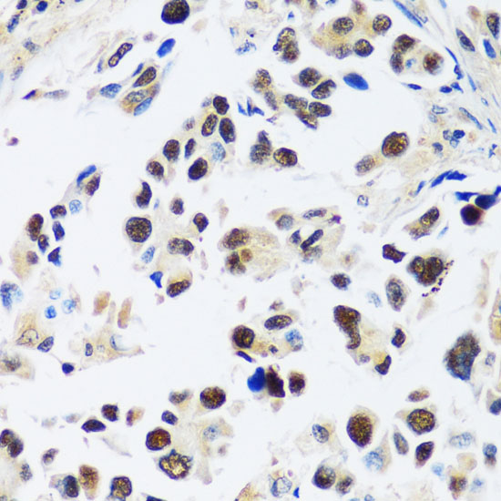 Immunohistochemistry of paraffin-embedded human lung cancer using ASCL4 antibody  at dilution of 1:100 