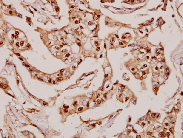 Immunohistochemistry (IHC) analyzes of MRP-S36 (V36) pAb in paraffin-embedded human breast carcinoma tissue at 1:50