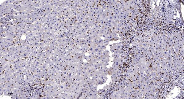Immunohistochemical analysis of paraffin-embedded human liver cancer