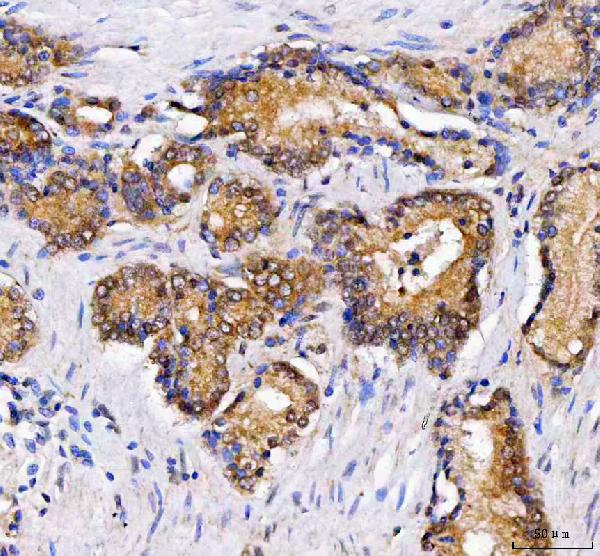 Figure 2. IHC analysis of LZIC using anti-LZIC antibody (A15087). LZIC was detected in a paraffin-embedded section of human prostatic cancer tissue. Heat mediated antigen retrieval was performed in EDTA buffer (pH 8.0, epitope retrieval solution). The tissue section was blocked with 10% goat serum. The tissue section was then incubated with 2 microg/ml rabbit anti-LZIC Antibody (A15087) overnight at 4°C. Peroxidase Conjugated Goat Anti-rabbit IgG was used as secondary antibody and incubated for 30 minutes at 37°C. The tissue section was developed using HRP Conjugated Rabbit IgG Super Vision Assay Kit (Catalog # SV0002) with DAB as the chromogen. Figure 2. IHC analysis of LZIC using anti-LZIC antibody (A15087). LZIC was detected in a paraffin-embedded section of human prostatic cancer tissue. Heat mediated antigen retrieval was performed in EDTA buffer (pH 8.0, epitope retrieval solution). The tissue section was blocked with 10% goat serum. The tissue section was then incubated with 2 microg/ml rabbit anti-LZIC Antibody (A15087) overnight at 4°C. Peroxidase Conjugated Goat Anti-rabbit IgG was used as secondary antibody and incubated for 30 minutes at 37°C. The tissue section was developed using HRP Conjugated Rabbit IgG Super Vision Assay Kit (Catalog # SV0002) with DAB as the chromogen.