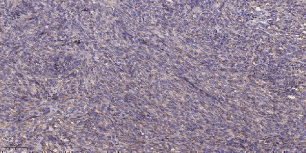 Immunohistochemical analysis of paraffin-embedded human Colon cancer