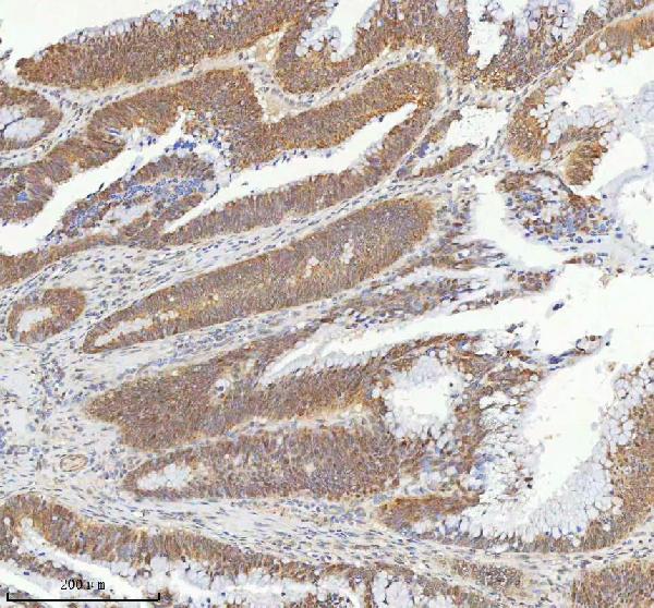 Figure 3. IHC analysis of METTL18 using anti-METTL18 antibody (A15133). METTL18 was detected in a paraffin-embedded section of human colon adenocarcinoma tissue. Heat mediated antigen retrieval was performed in EDTA buffer (pH 8.0, epitope retrieval solution). The tissue section was blocked with 10% goat serum. The tissue section was then incubated with 2 microg/ml rabbit anti-METTL18 Antibody (A15133) overnight at 4°C. Peroxidase Conjugated Goat Anti-rabbit IgG was used as secondary antibody and incubated for 30 minutes at 37°C. The tissue section was developed using HRP Conjugated Rabbit IgG Super Vision Assay Kit (Catalog # SV0002) with DAB as the chromogen.