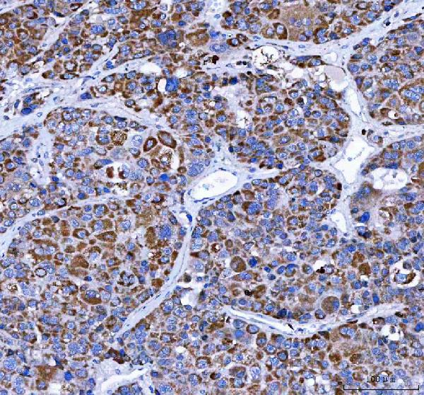 Figure 2. IHC analysis of LRRN4 using anti-LRRN4 antibody (A15151-2). LRRN4 was detected in a paraffin-embedded section of human liver cancer tissue. Heat mediated antigen retrieval was performed in EDTA buffer (pH 8.0, epitope retrieval solution). The tissue section was blocked with 10% goat serum. The tissue section was then incubated with 2 microg/ml rabbit anti-LRRN4 Antibody (A15151-2) overnight at 4°C. Peroxidase Conjugated Goat Anti-rabbit IgG was used as secondary antibody and incubated for 30 minutes at 37°C. The tissue section was developed using HRP Conjugated Rabbit IgG Super Vision Assay Kit (Catalog # SV0002) with DAB as the chromogen.
