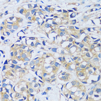Immunohistochemistry of paraffin-embedded human breast cancer using CABP7 antibody  at dilution of 1:100 