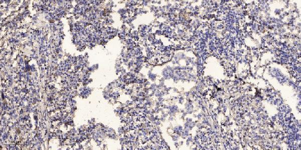 Immunohistochemical analysis of paraffin-embedded human Squamous cell carcinoma of lung