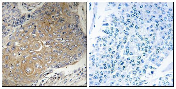 Immunohistochemistry analysis of paraffin-embedded human lung carcinoma tissue, using MRPS33 Antibody