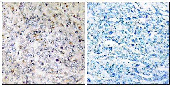 Immunohistochemistry analysis of paraffin-embedded human breast carcinoma tissue, using PDIK1L Antibody