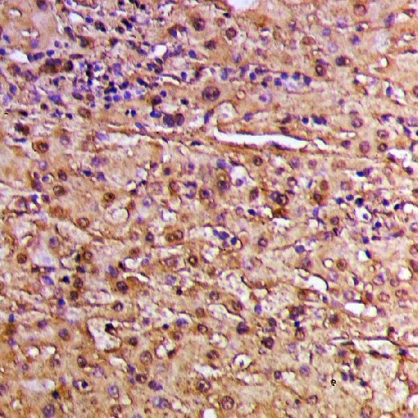 Immunohistochemistry (IHC) analyzes of INTS2 polyclonal antibody in paraffin-embedded human liver cancer tissue at 1:50