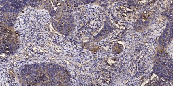 Immunohistochemical analysis of paraffin-embedded human Squamous cell carcinoma of lung