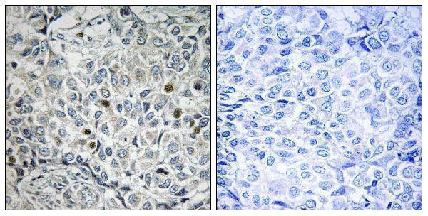 Immunohistochemistry analysis of paraffin-embedded human breast carcinoma, using USP53 Antibody