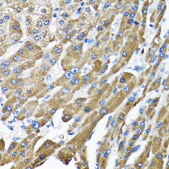 Immunohistochemistry of paraffin-embedded human liver cancer using THUMPD3 Rabbit pAb  at dilution of 1:200 