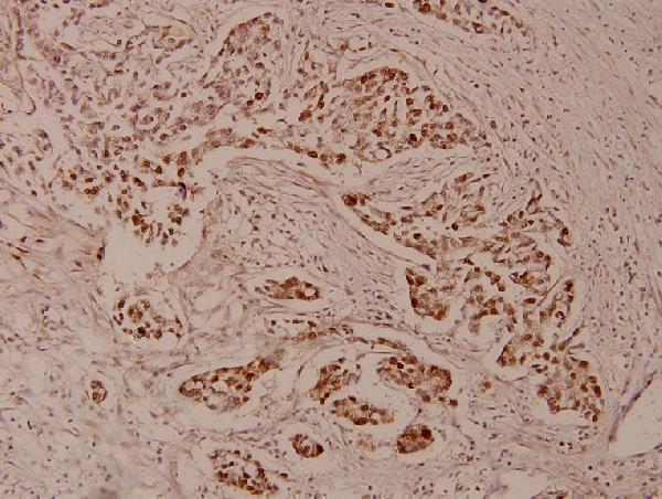 Immunohistochemistry (IHC) analyzes of ZNF329 (D123) pAb in paraffin-embedded human breast carcinoma tissue at 1:100